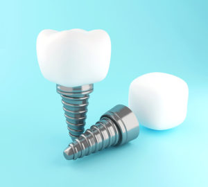 3d-dental-tooth-implant-K8W7QWP