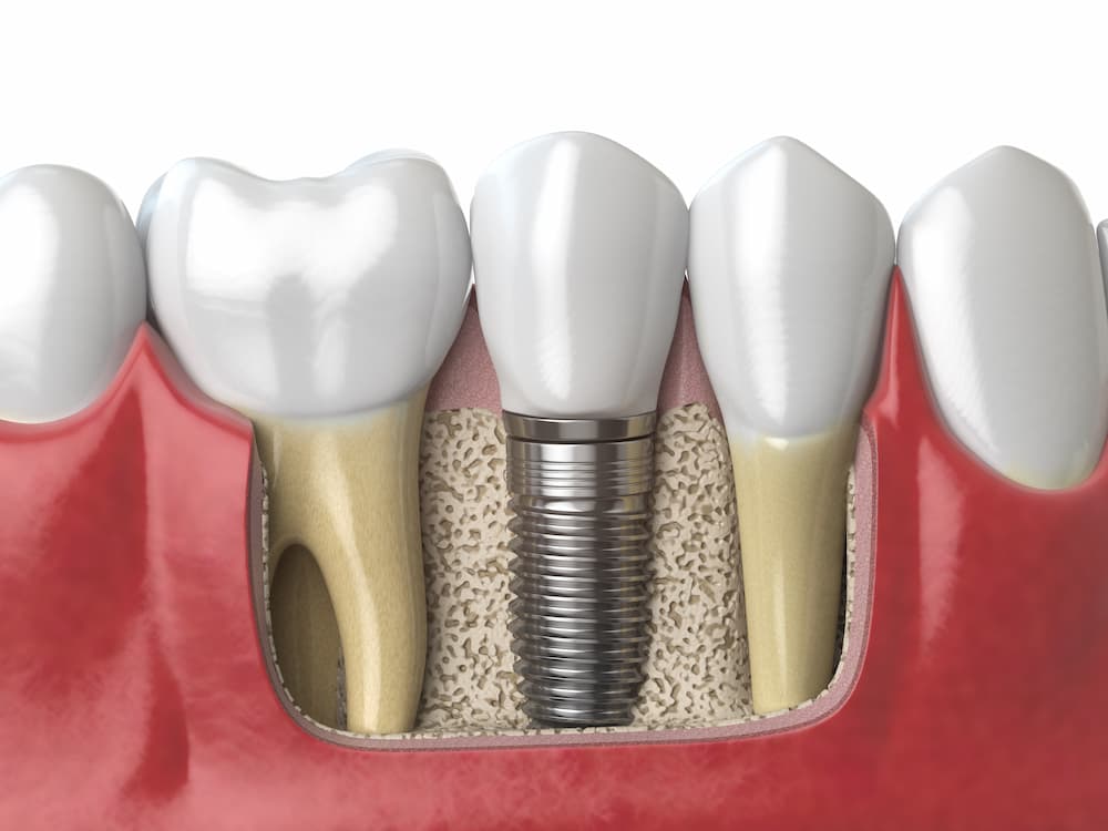 Read more about the article 植牙費用一顆要價高，裡面究竟包含哪些治療
